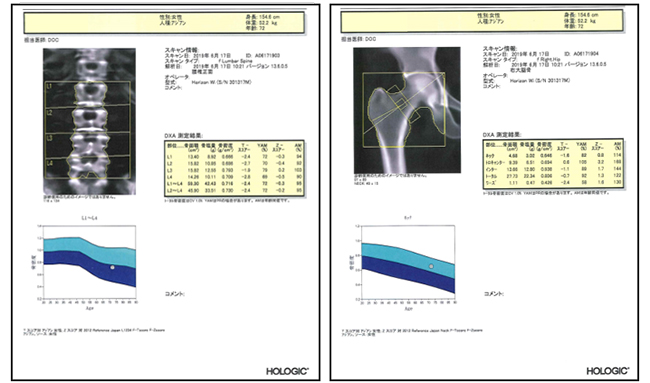 DEXA 検査レポート例